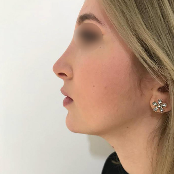 profiloplasty after Dubai — natural outcome | Dr. Kotti (11)