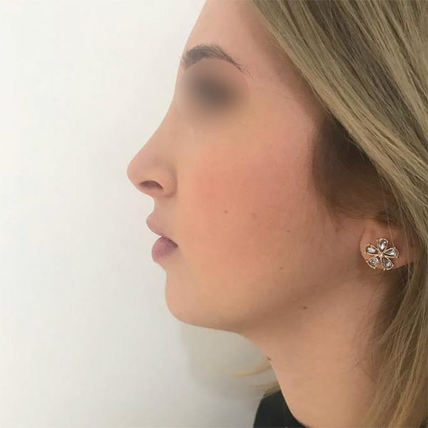 profiloplasty before Dubai — natural outcome | Dr. Kotti (11)