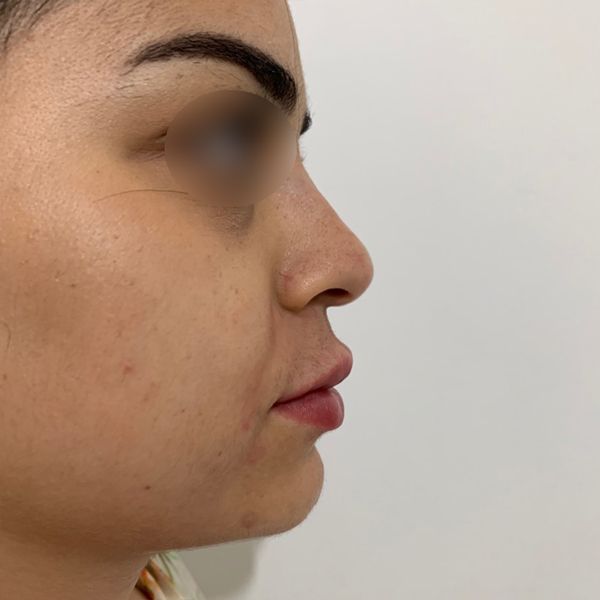 profiloplasty after Dubai — natural outcome | Dr. Kotti (12)