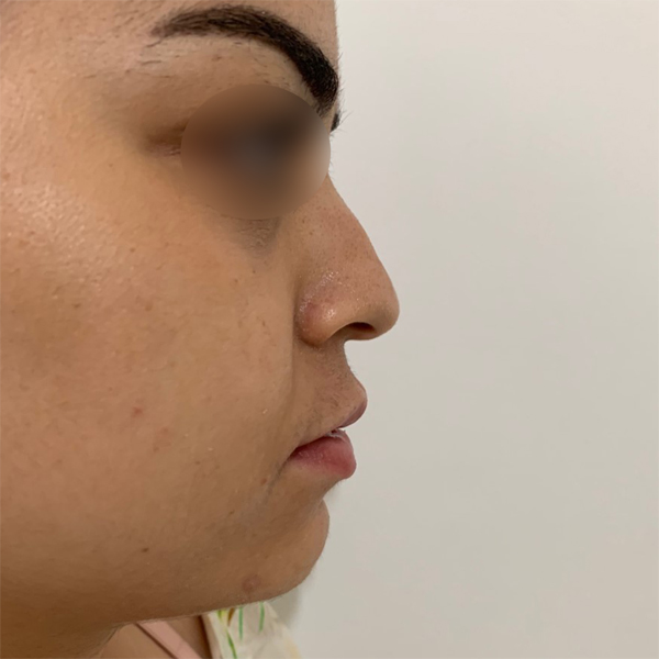 profiloplasty before Dubai — natural outcome | Dr. Kotti (12)