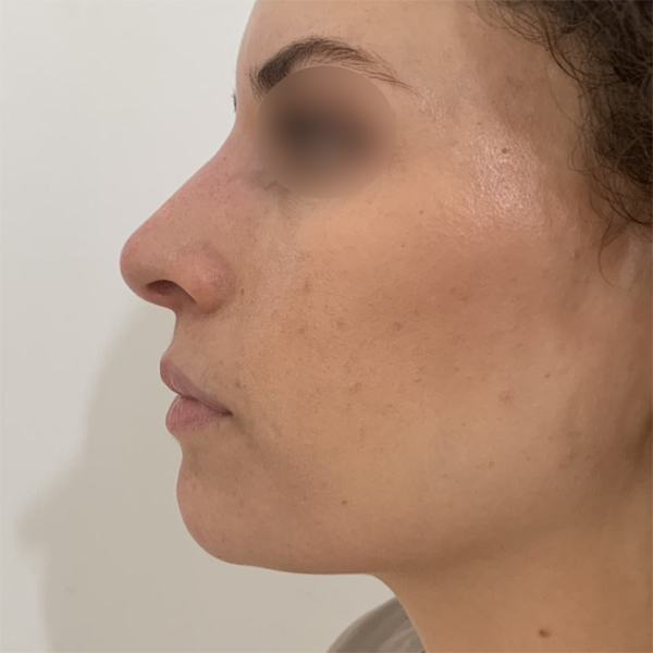 profiloplasty after Dubai — natural outcome | Dr. Kotti (13)