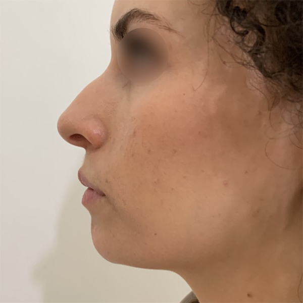 profiloplasty before Dubai — natural outcome | Dr. Kotti (13)