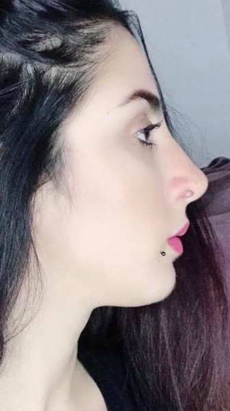 profiloplasty after Dubai — natural outcome | Dr. Kotti (14)