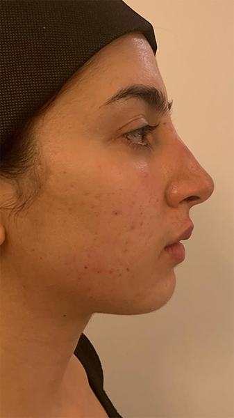 profiloplasty before Dubai — natural outcome | Dr. Kotti (14)