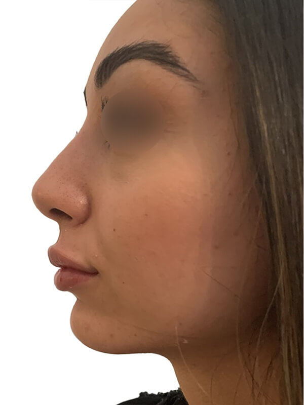 profiloplasty after Dubai — natural outcome | Dr. Kotti (2)