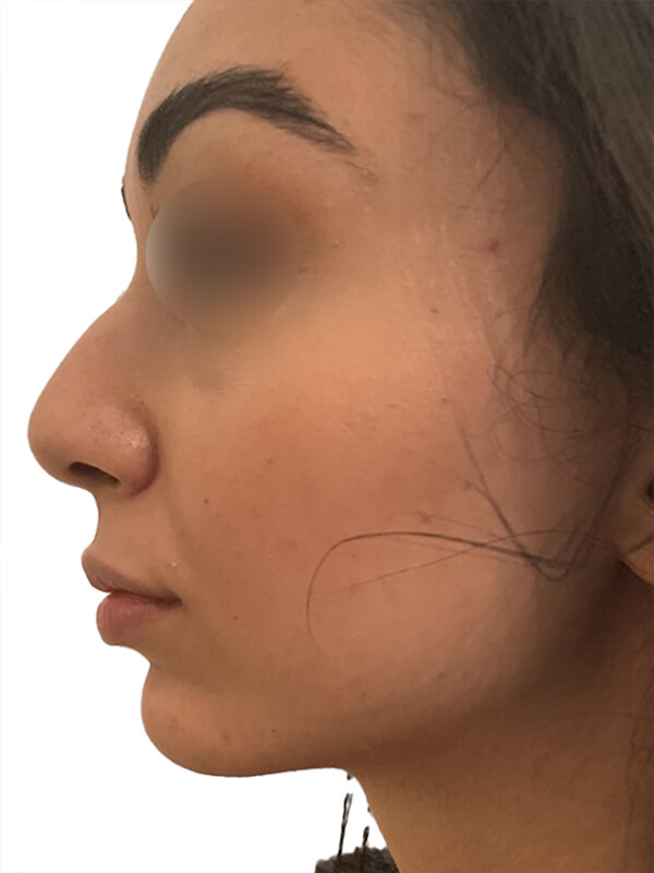 profiloplasty before Dubai — natural outcome | Dr. Kotti (2)