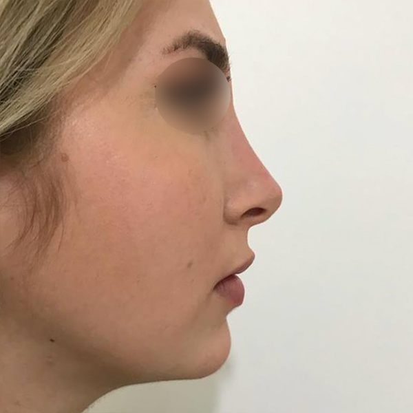profiloplasty after Dubai — natural outcome | Dr. Kotti (3)