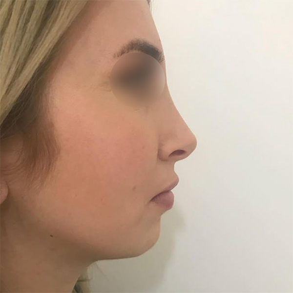 profiloplasty before Dubai — natural outcome | Dr. Kotti (3)