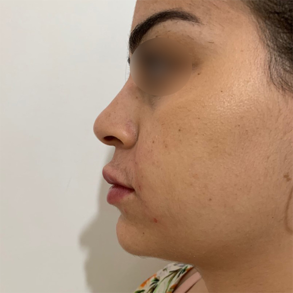profiloplasty after Dubai — natural outcome | Dr. Kotti (4)