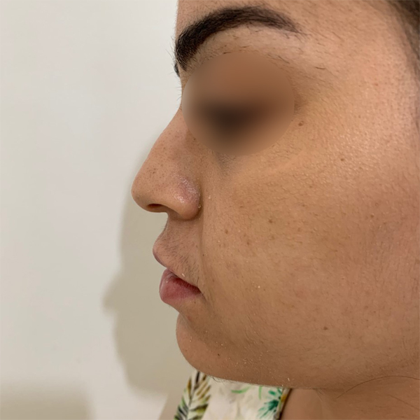 profiloplasty before Dubai — natural outcome | Dr. Kotti (4)