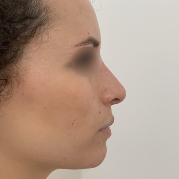 profiloplasty after Dubai — natural outcome | Dr. Kotti (5)