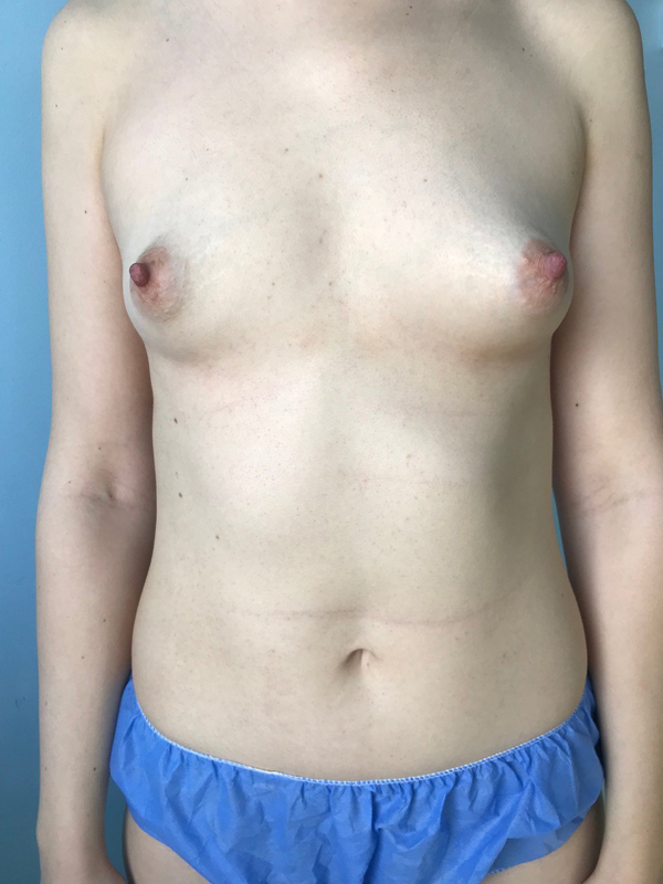 تصحيح الثدي الأنبوبي (Tuberous Breasts) after Dubai — natural outcome | Dr. Kotti (34)