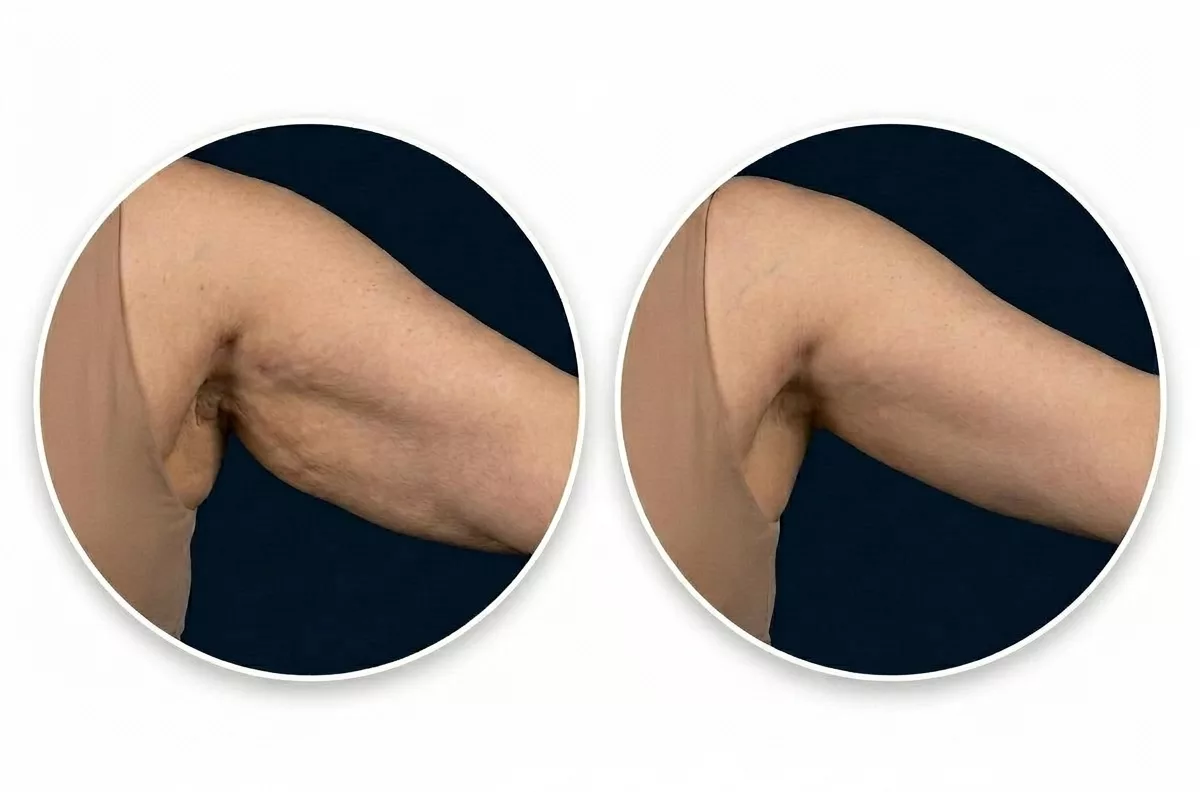 Arm Lift Surgery (Brachioplasty) Dubai — Dr. Bouraoui Kotti