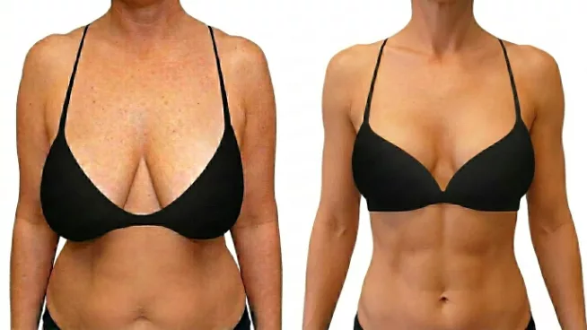Breast Lift (Mastopexy) Dubai