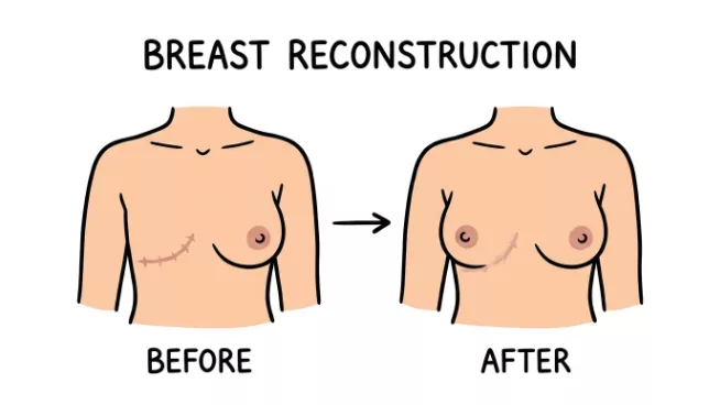 Breast Reconstruction Surgery Dubai — Dr. Bouraoui Kotti