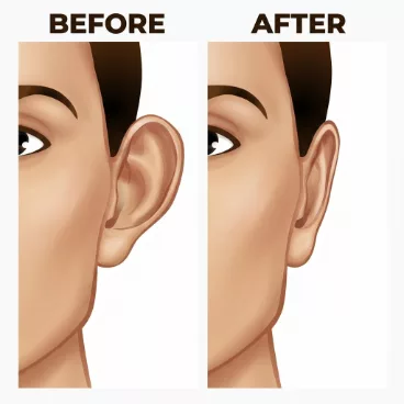 Otoplasty Dubai — Dr. Bouraoui Kotti