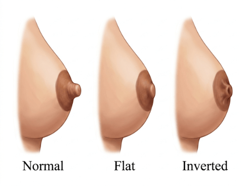تصحيح الثدي الأنبوبي Dubai — Dr. Bouraoui Kotti