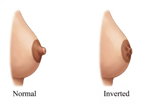 Inverted Nipple Correction (Nippleplasty) Dubai