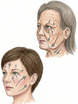 Midface Lift