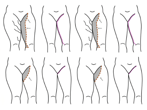 Lifting des Cuisses Dubai — Dr. Bouraoui Kotti