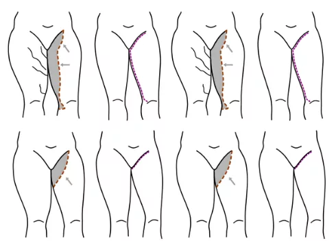 Thigh Lift Dubai — Dr. Bouraoui Kotti