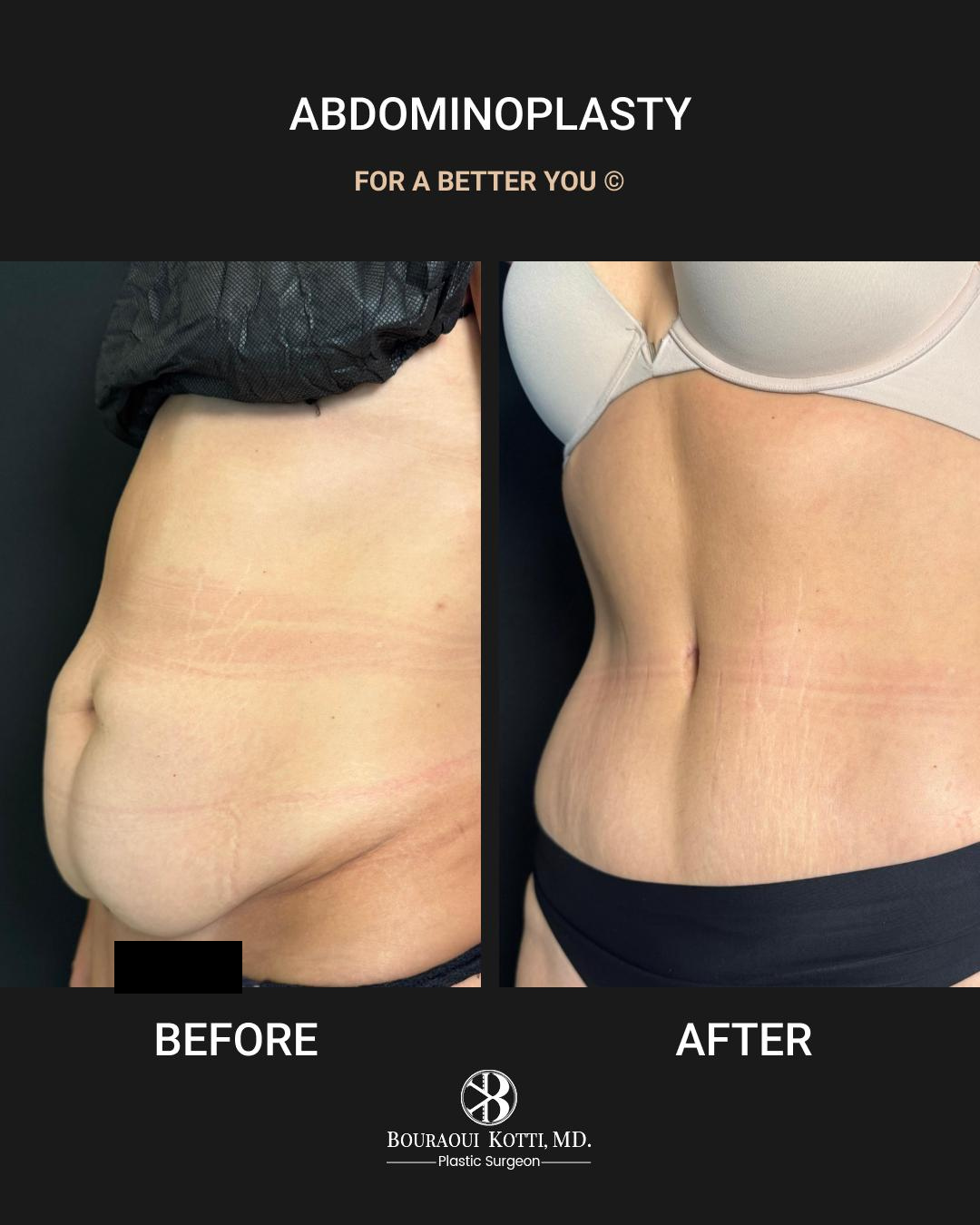 Tummy Tuck (Abdominoplasty) before Dubai