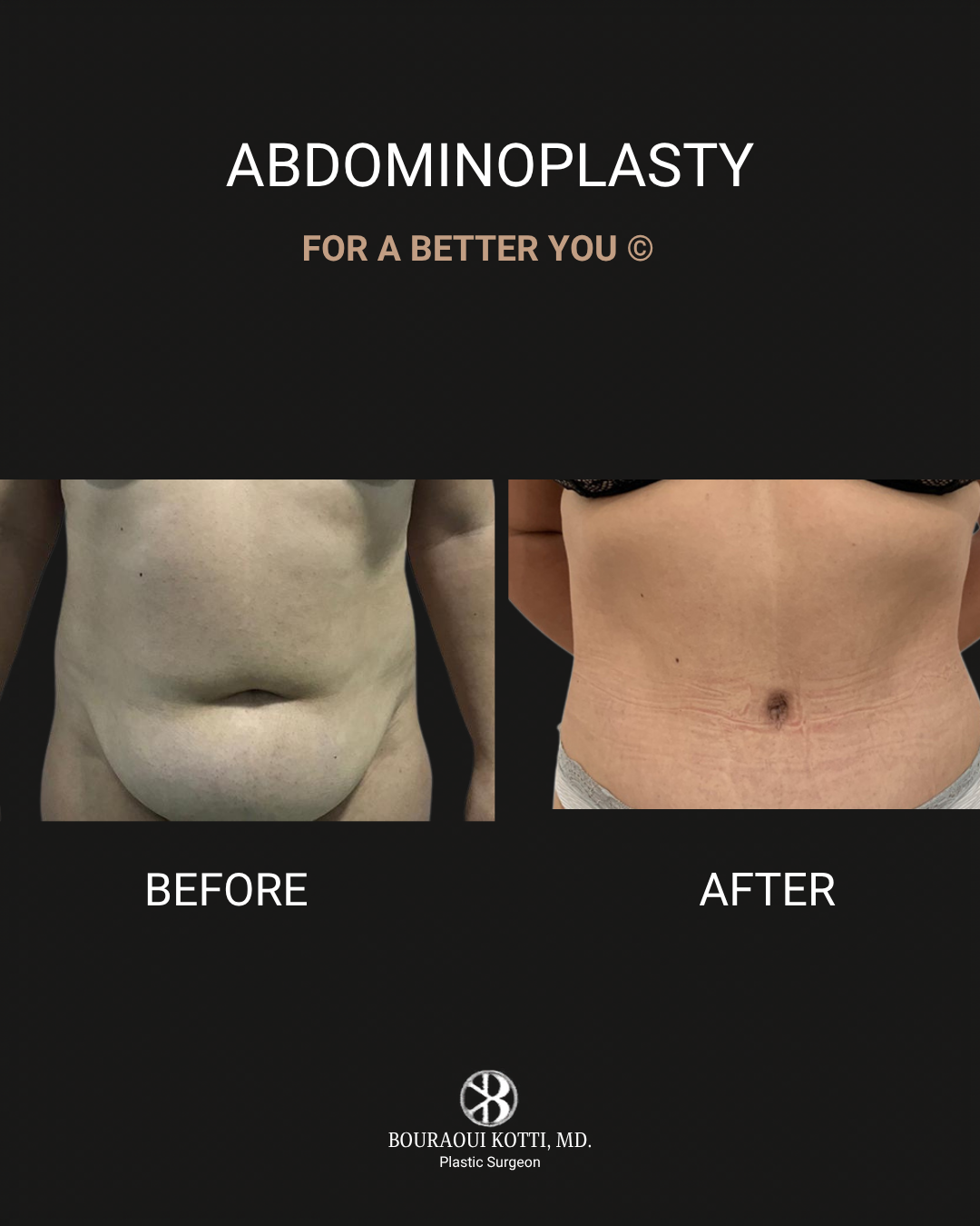 Tummy Tuck (Abdominoplasty) after Dubai