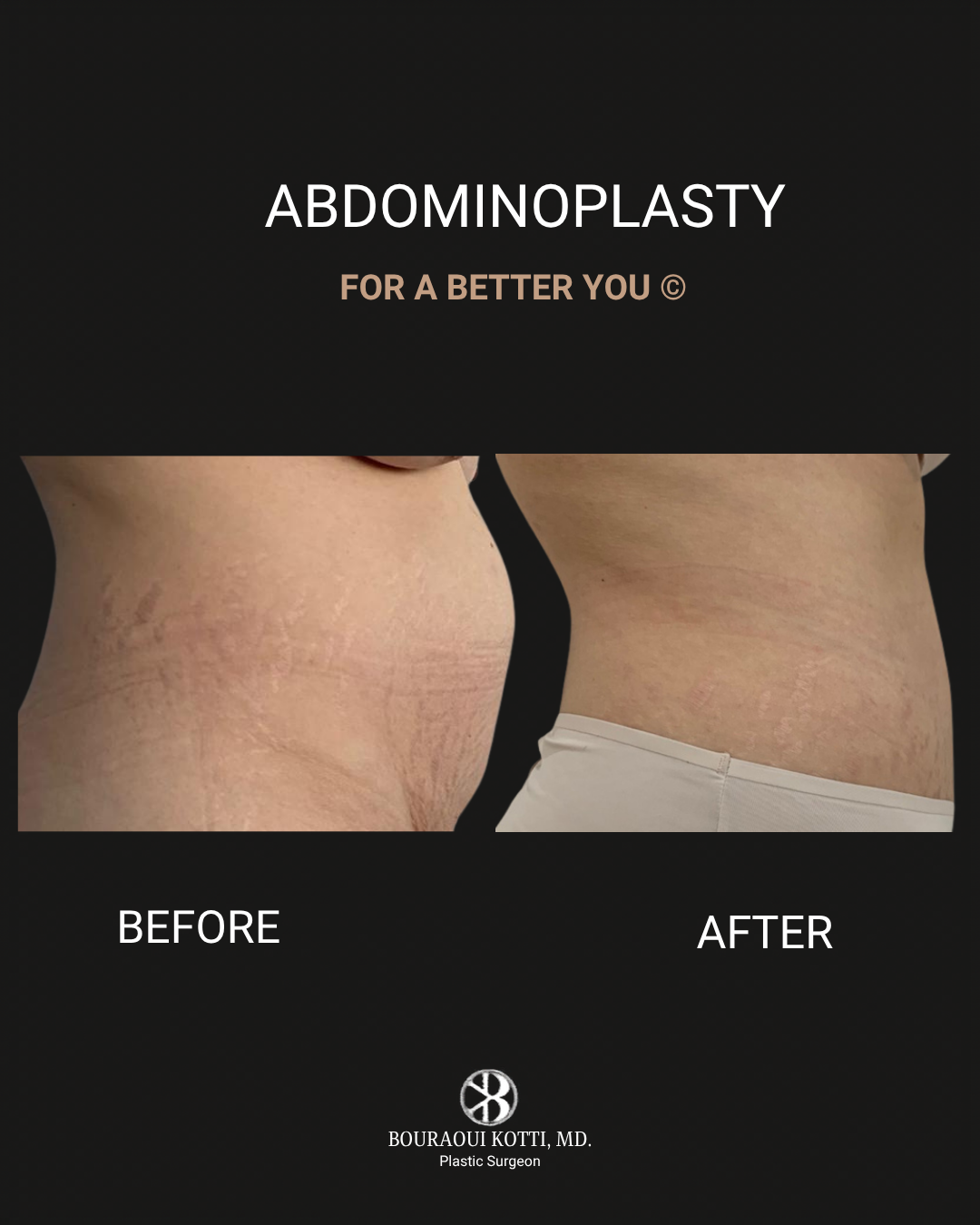 Tummy Tuck (Abdominoplasty) before Dubai