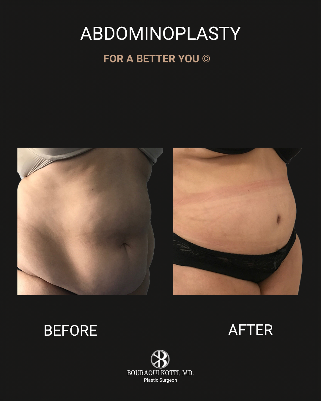 Tummy Tuck (Abdominoplasty) after Dubai