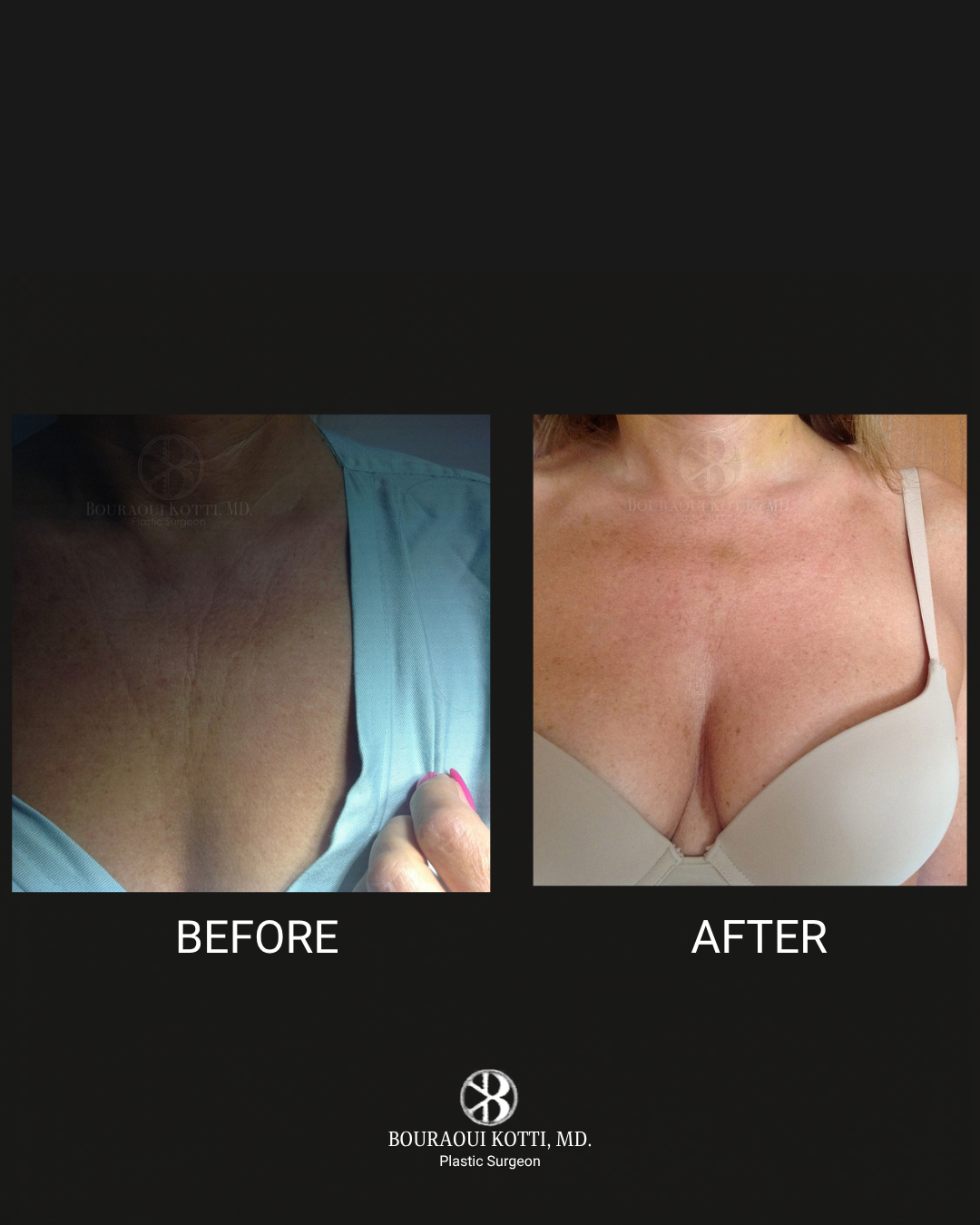 Botox (Botulinum Toxin) before Dubai