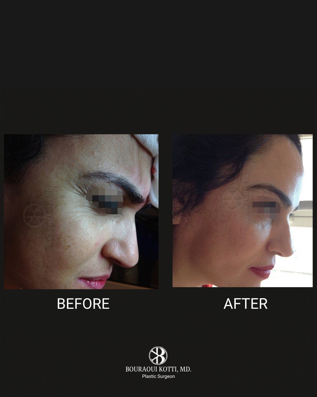 Botox (Botulinum Toxin) after Dubai