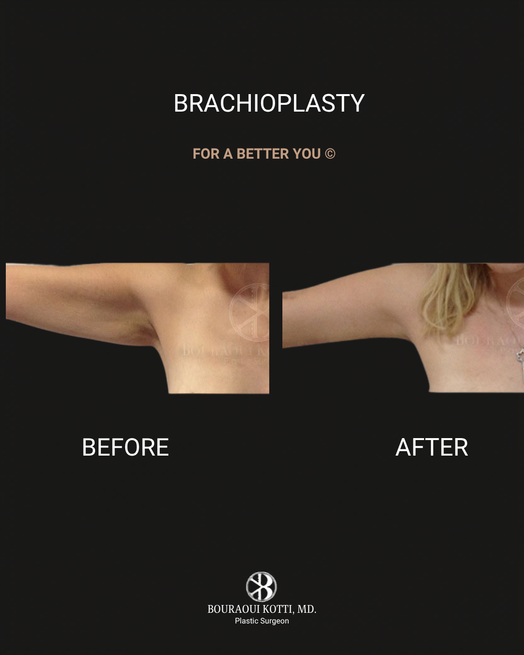 Arm Lift Surgery (Brachioplasty) before Dubai
