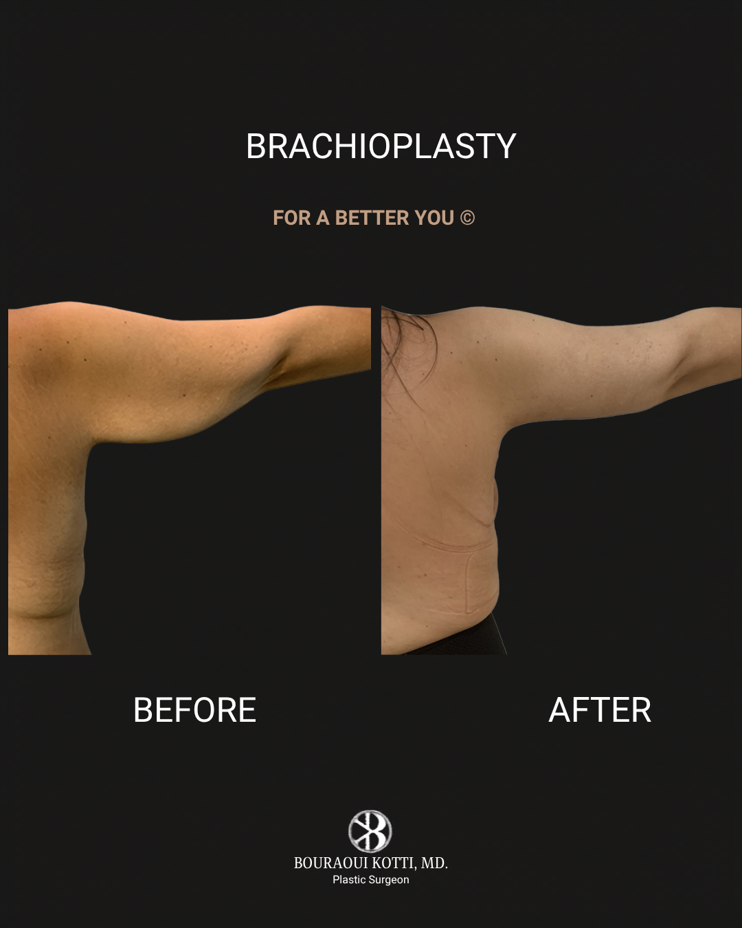 Arm Lift Surgery (Brachioplasty) after Dubai