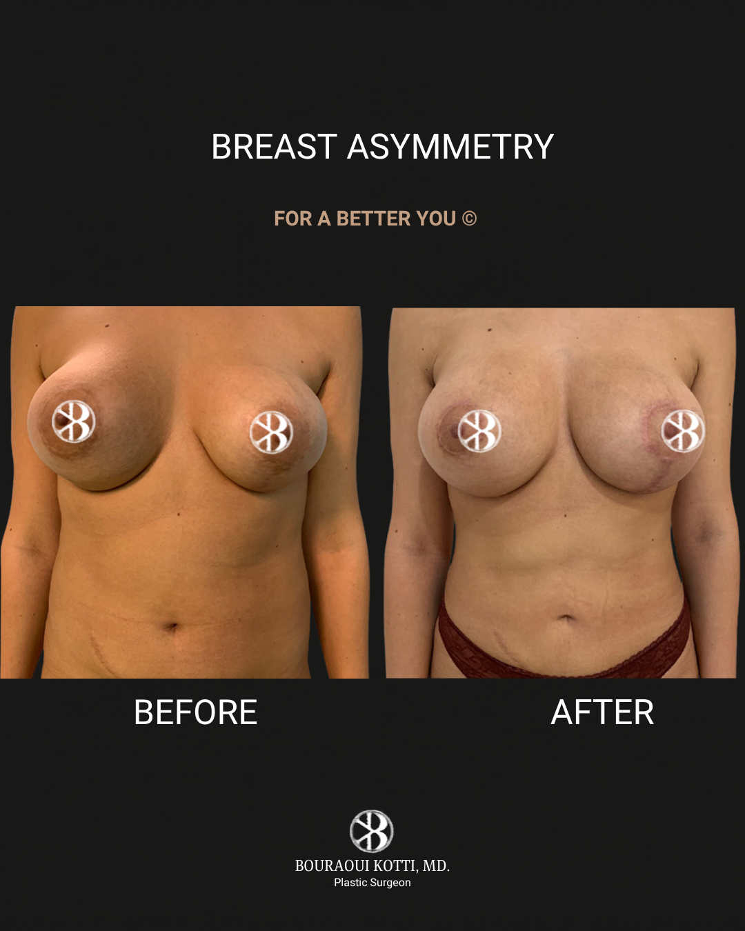 Breast Asymmetry Correction before Dubai