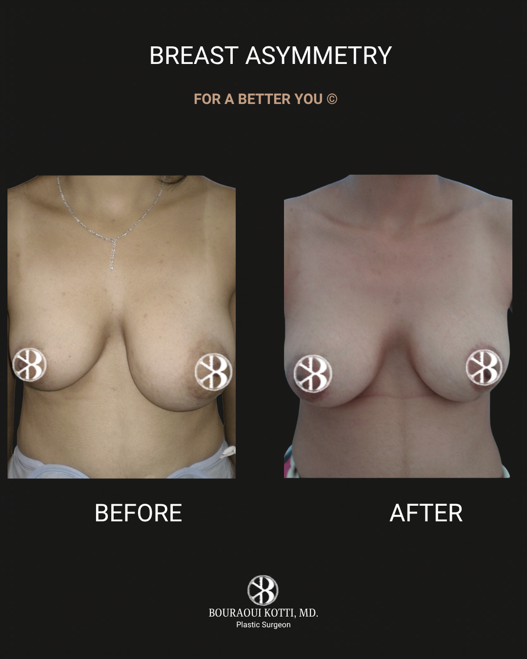 Breast Asymmetry Correction after Dubai