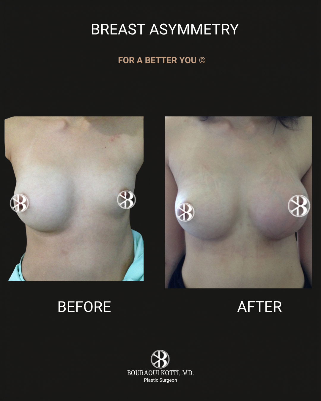 Breast Asymmetry Correction before Dubai