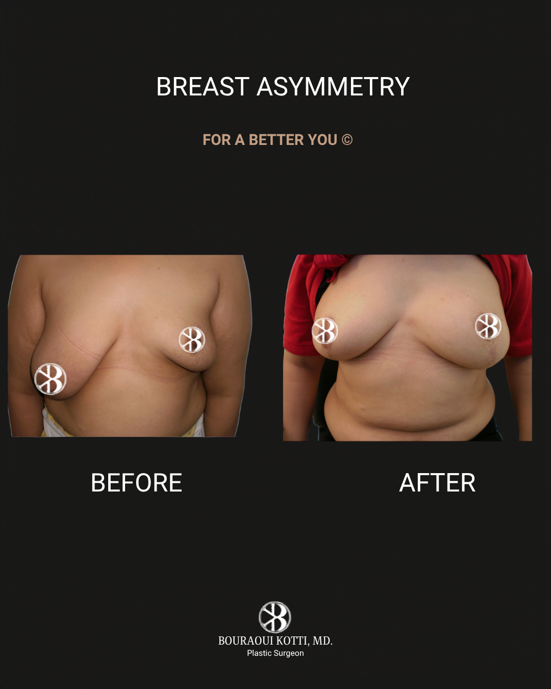 Breast Asymmetry Correction after Dubai