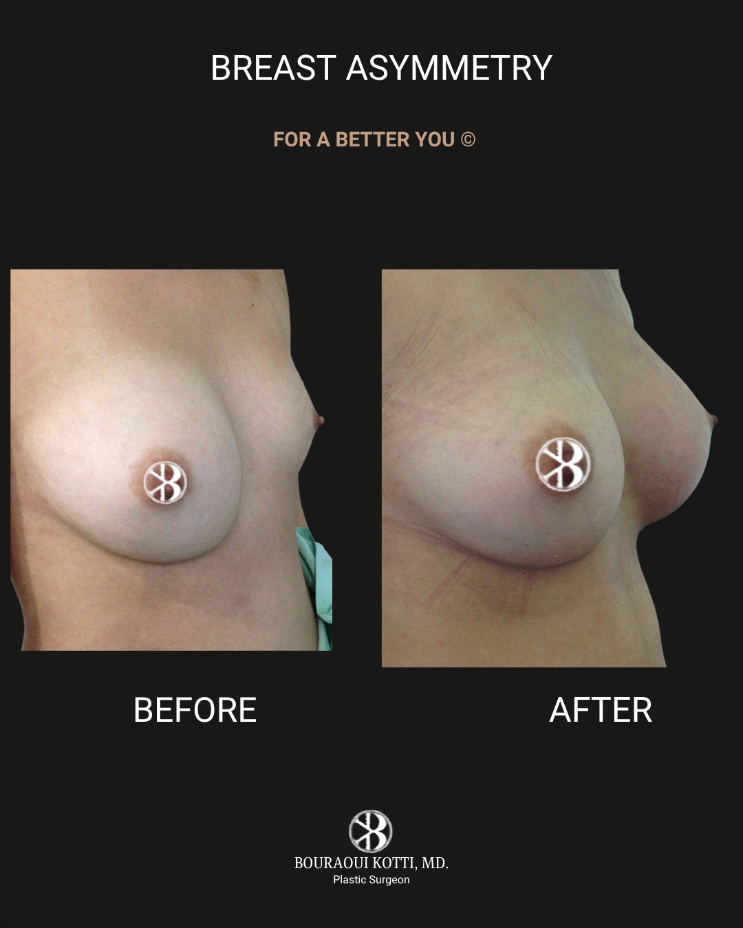 Breast Asymmetry Correction before Dubai