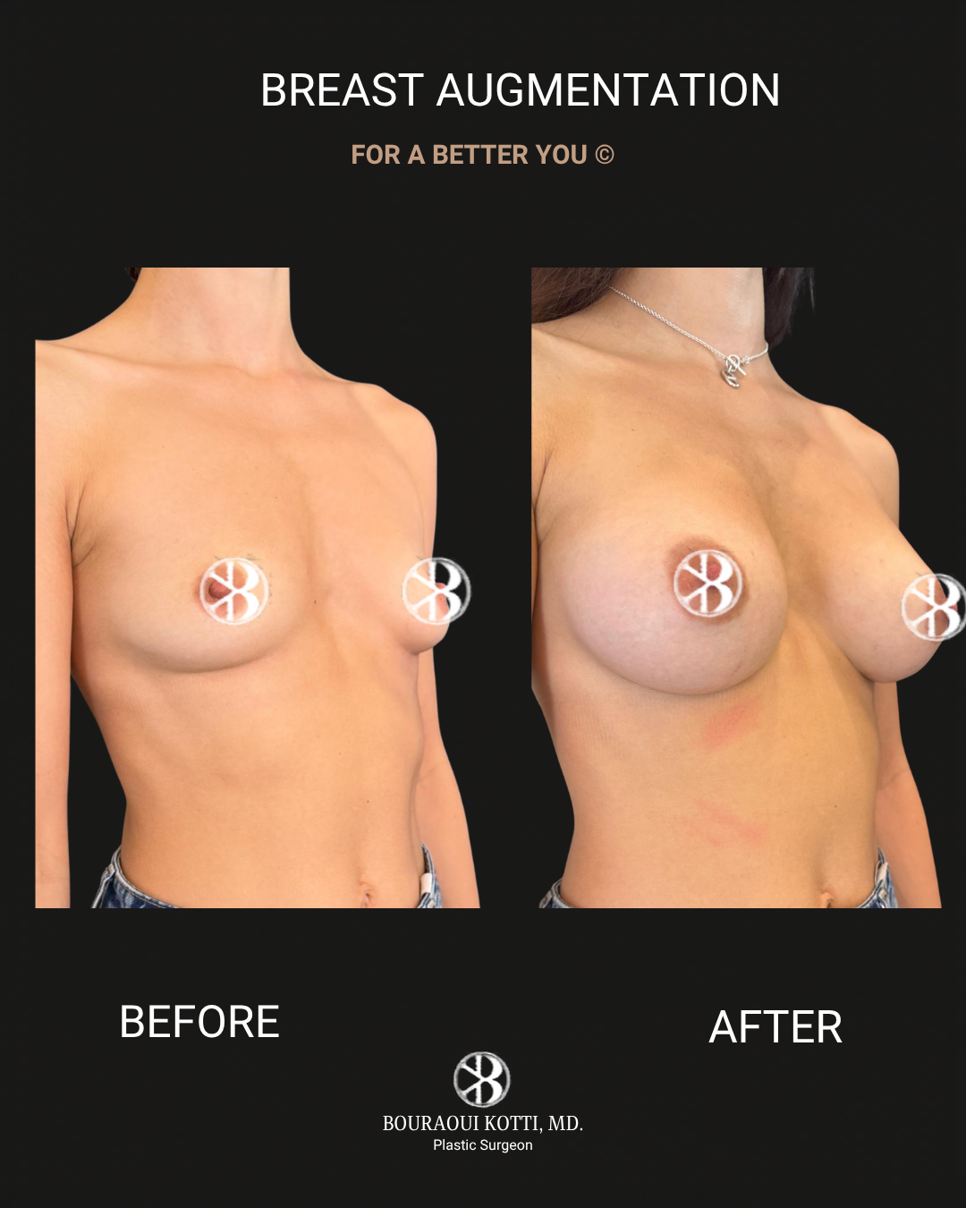 Breast Augmentation before Dubai