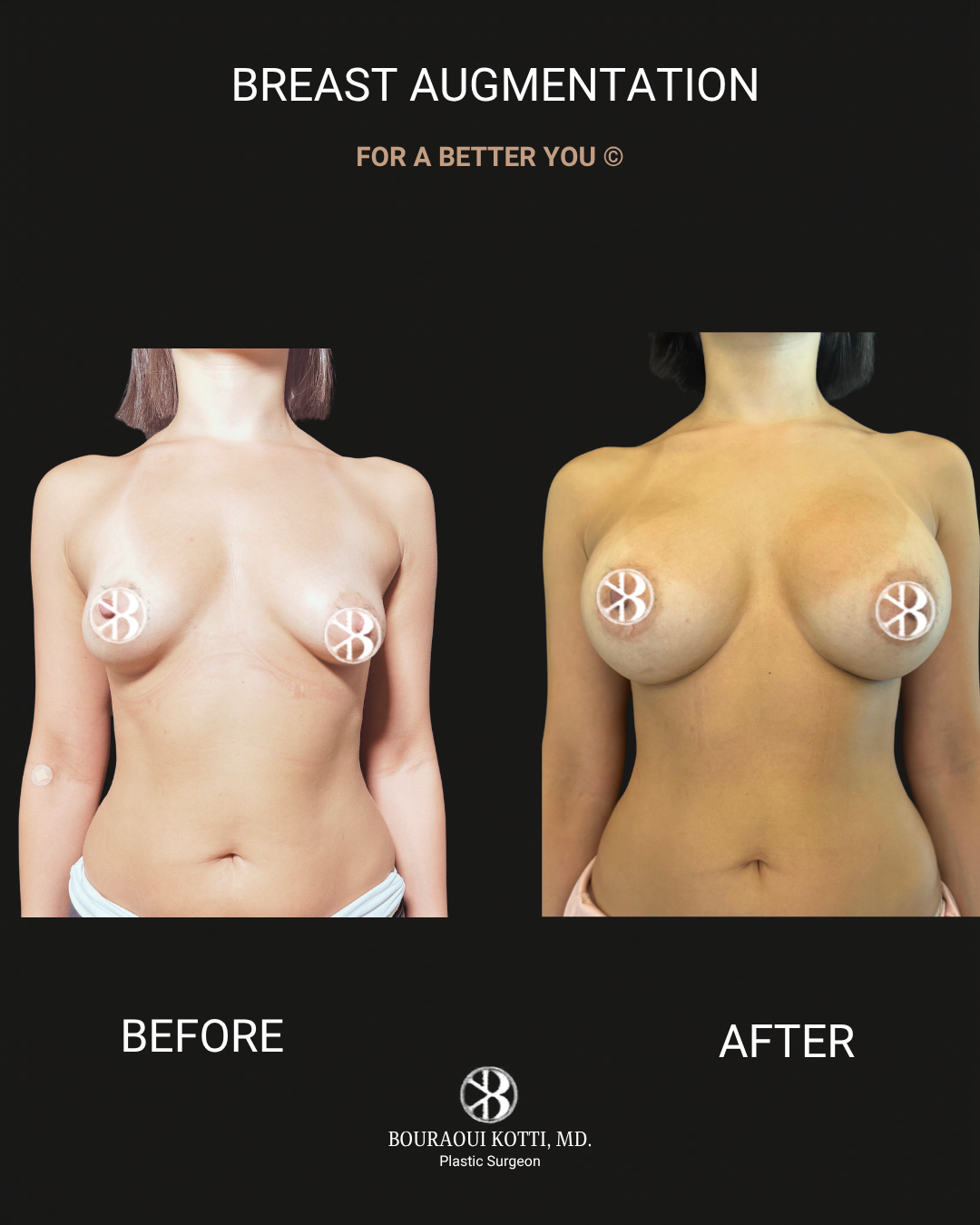 Breast Augmentation after Dubai