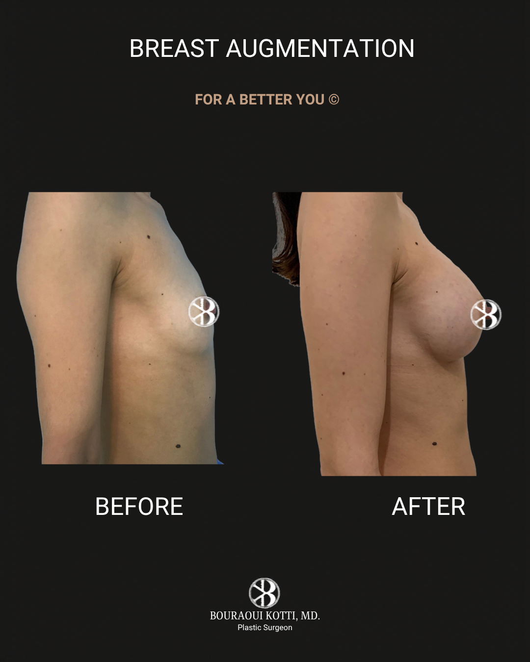 Breast Augmentation before Dubai