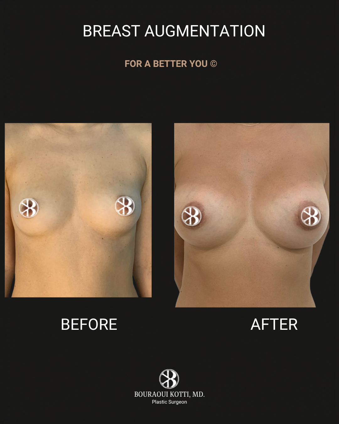 Breast Augmentation after Dubai