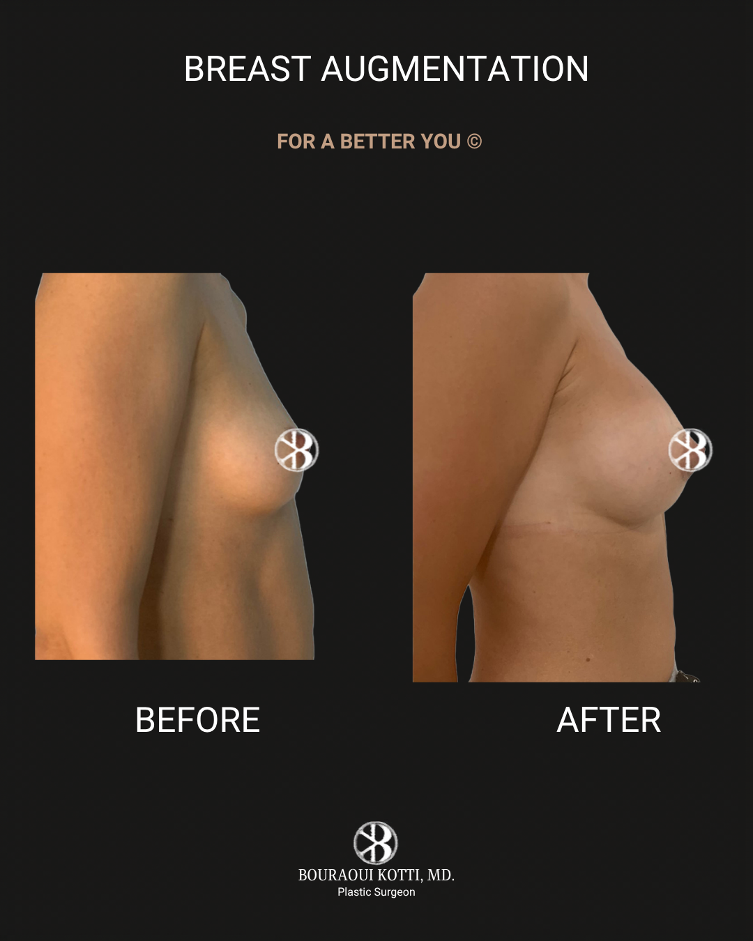 Breast Augmentation before Dubai