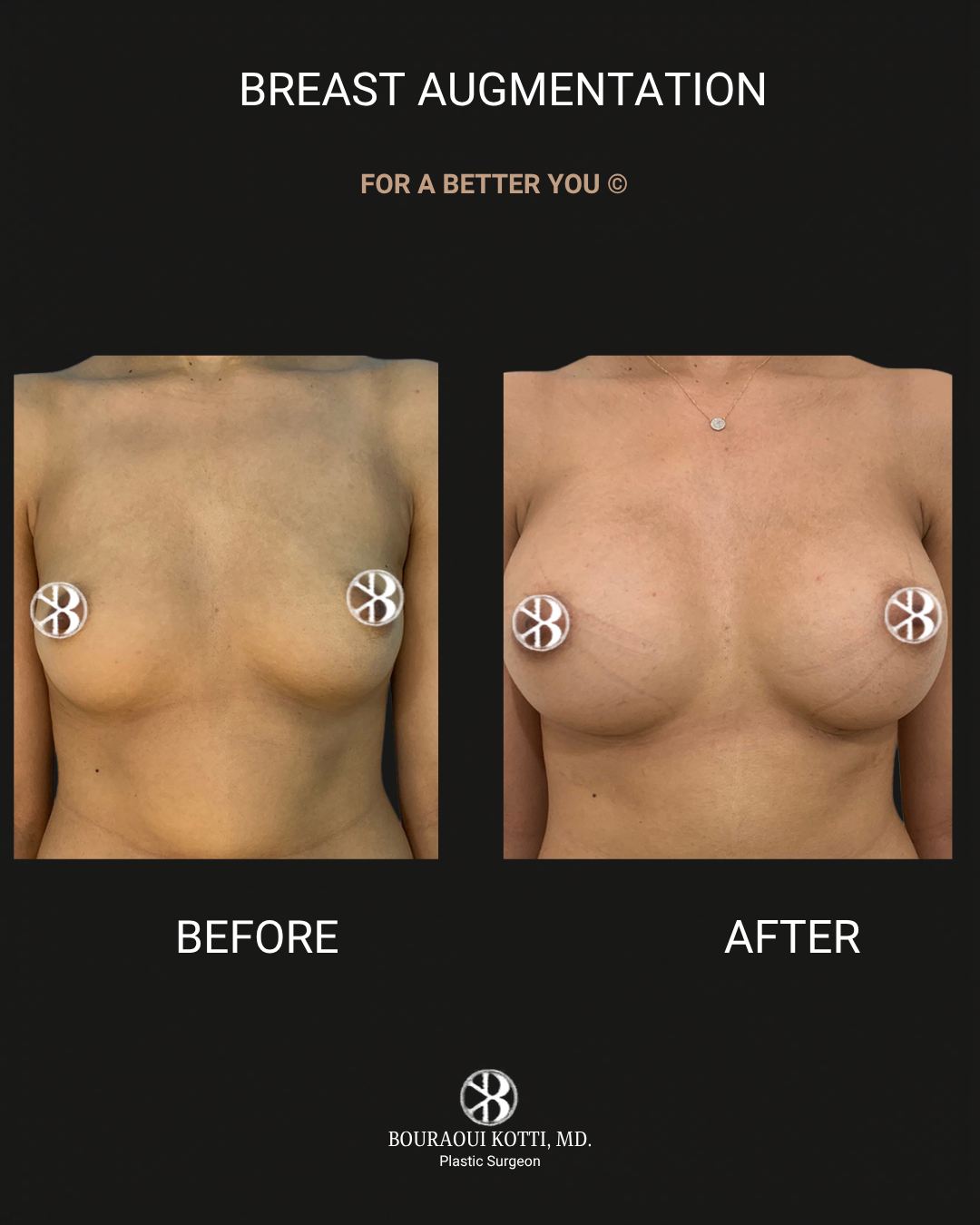 Breast Augmentation after Dubai