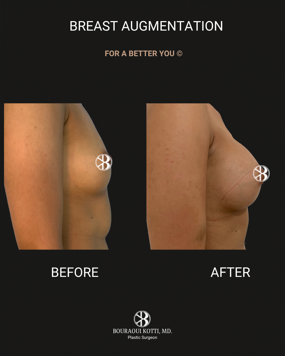 Breast Augmentation before Dubai