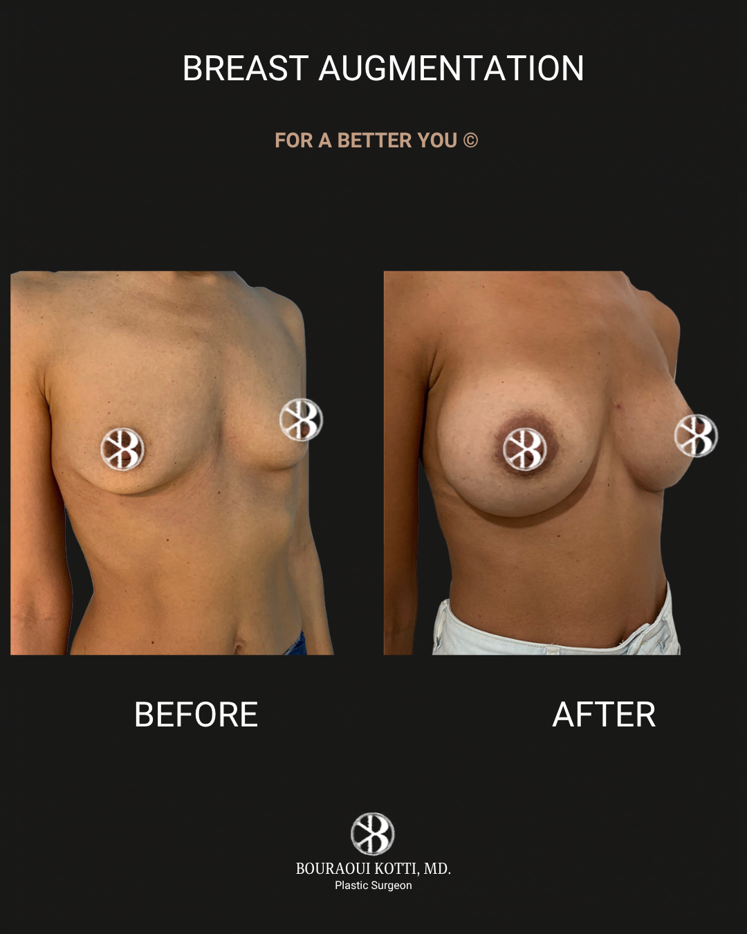 Breast Augmentation after Dubai