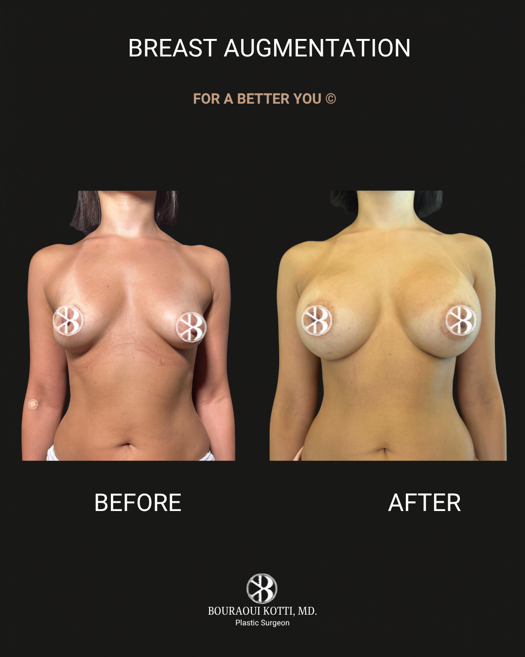 Breast Augmentation before Dubai