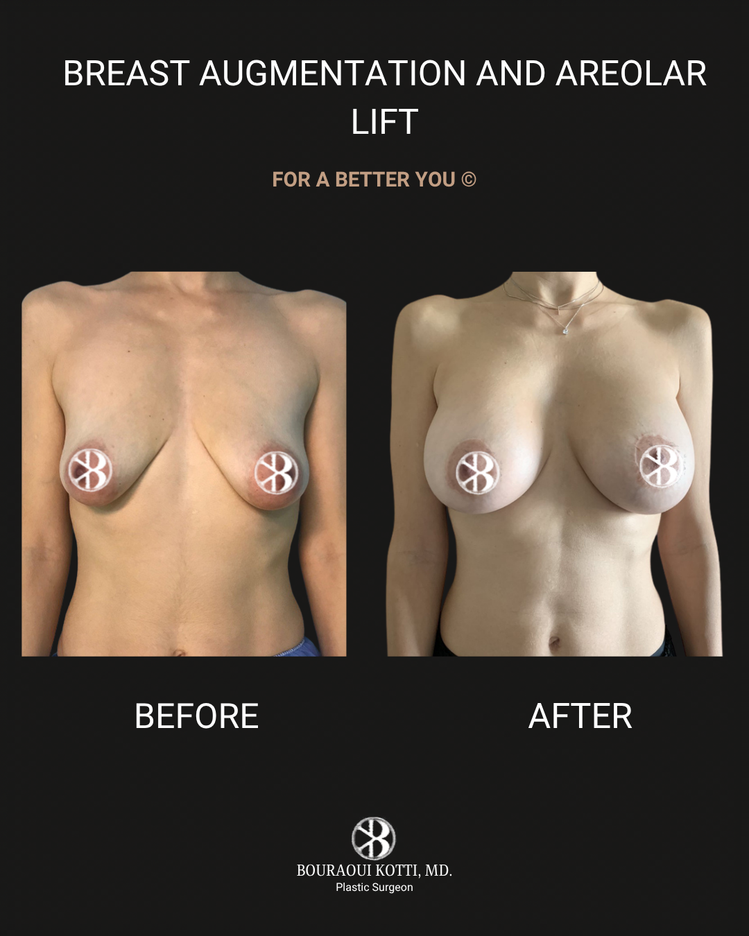 Breast Augmentation after Dubai