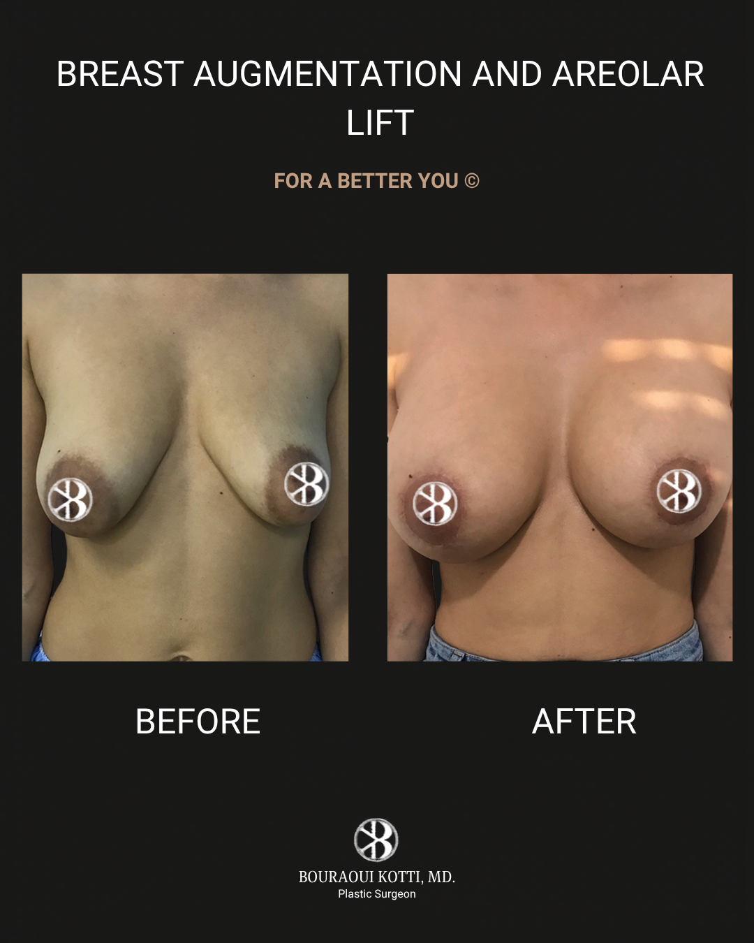 Breast Augmentation before Dubai