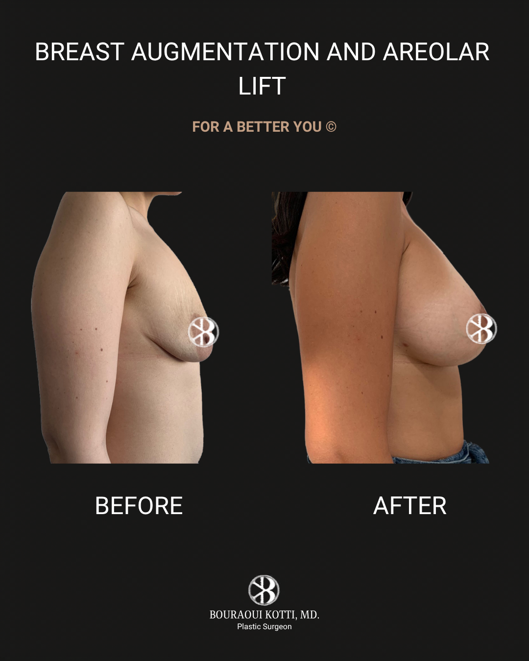 Breast Augmentation before Dubai
